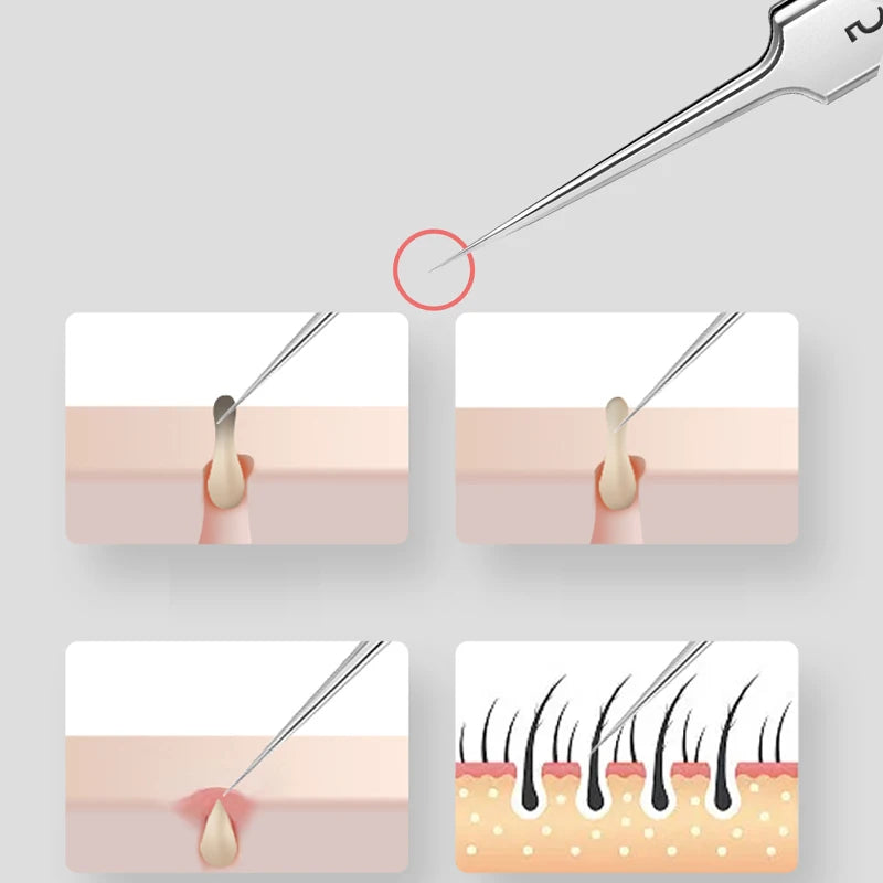 PrecisionTip Ultra-Fine Stainless Blackhead Tweezer Set